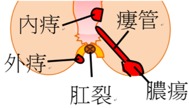 肛門疾病治療