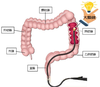 大腸鏡